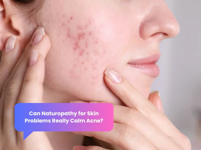 Woman with inflamed facial acne on cheek, illustrating skin condition treated by a naturopath for acne.