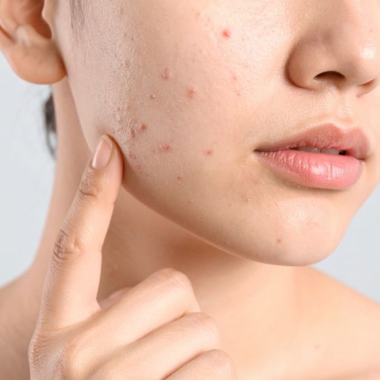 acne naturopath in wollongong support bad skin